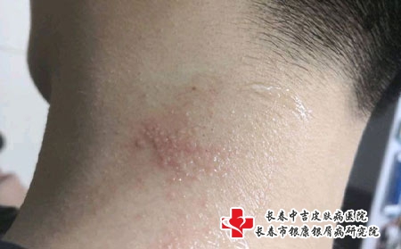 带状疱疹治疗并不难，选对方法很重要