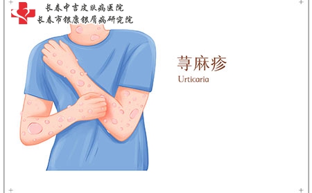 荨麻疹