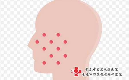 起痘痘的原因