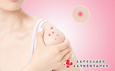 皮肤瘙痒的治疗方法