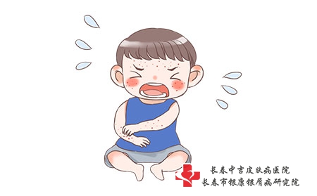 宝宝湿疹怎么办？宝宝湿疹的日常护理