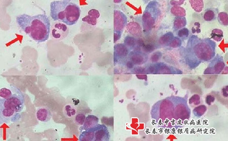 要想治疗荨麻疹应该怎么做？