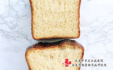导致脂溢性皮炎的病因是什么？