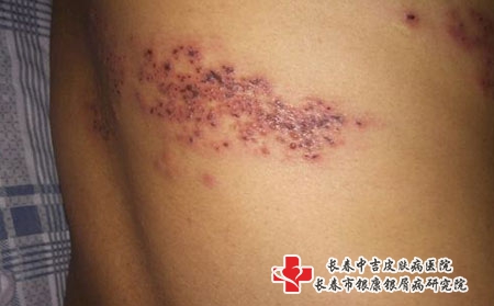 带状疱疹的病因有哪些?