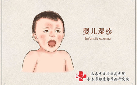 孩子得了湿疹要怎么办才好？