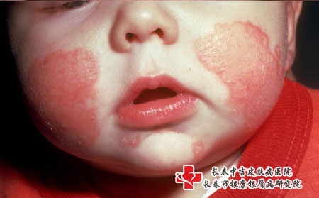 婴儿湿疹的中医疗法