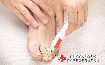 牛皮癣患者脱皮该怎么办? 牛皮癣患者脱皮该怎么办?
