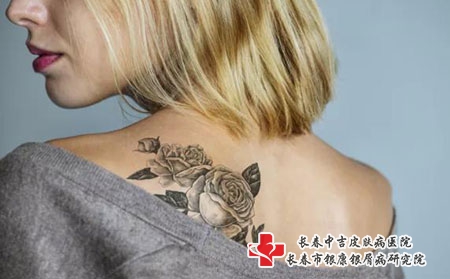 什么时候治疗太田痣最好？