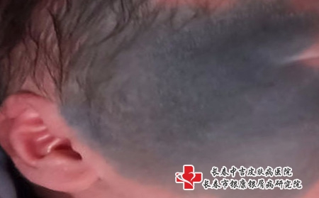 哪个医疗机构适合长春治疗青色胎记？