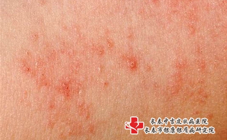 光敏性皮炎应注意什么呢？