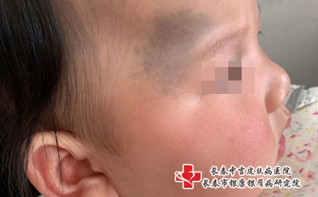 孩子看冬奥会后视力不好来院检查，结果是有了太田痣