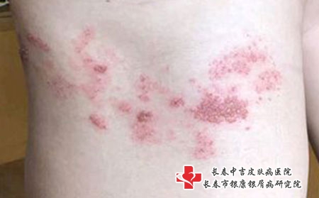 治疗带状疱疹以及缓解神经痛的药物 治疗带状疱疹以及缓解神经痛的药物