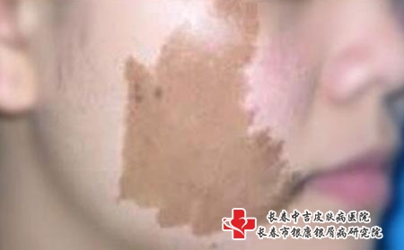 雀斑和黄褐斑有什么不同呢？