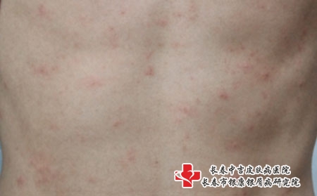 不同类型的荨麻疹有什么症状表现