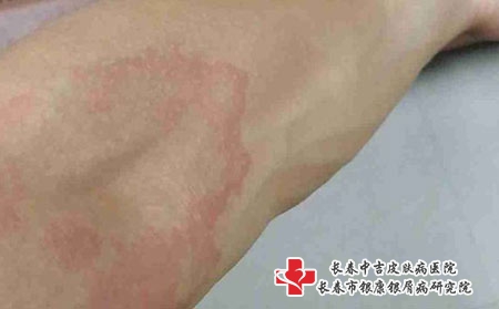 慢性荨麻疹的鉴别诊断
