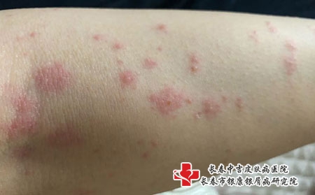 中药能有效地治疗带状疱疹吗