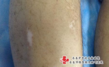 白癜风长在四肢怎么办呐