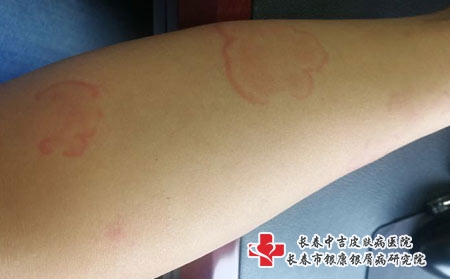 荨麻疹治疗的方法有哪些
