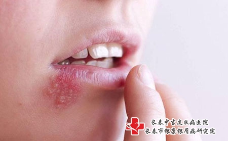 治疗带状疱疹的妙招有哪些