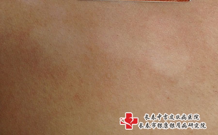 白癜风患者需要终身服药吗