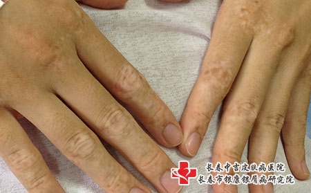 白癜风治好不易，要怎么控制复发