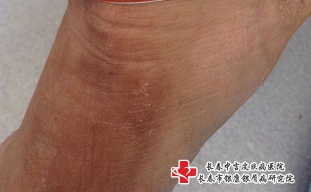 临床治疗湿疹用的是什么方法