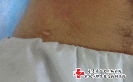 白癜风长在四肢怎么办