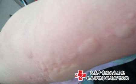 日常预防荨麻疹的简单方法有什么