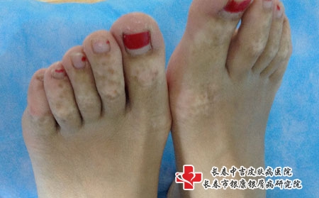 白癜风不治疗会怎样