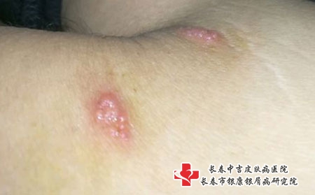 如何治疗手臂疱疹