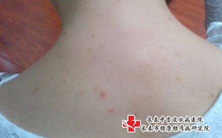 疫情期间，青春痘的日常护理