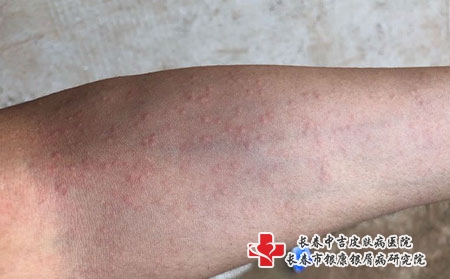 治疗荨麻疹可以吃什么药