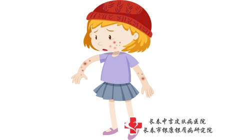 长春中吉皮肤病医院顺丰快递可以邮药吗 长春中吉皮肤病医院顺丰快递可以邮药吗