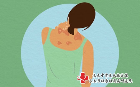 夏季到了，急性湿疹的治疗方法你知道吗?