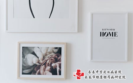 在吉林如何选择治疗牛皮癣好的医院呢