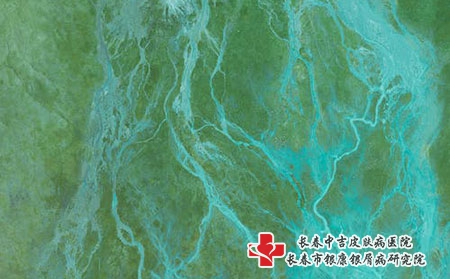 夏季荨麻疹的预防措施是什么