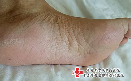 怎么引起的掌跖脓疱银屑病是什么诱发的