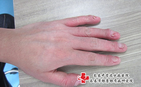 生物制剂治疗牛皮癣价位一针多少钱