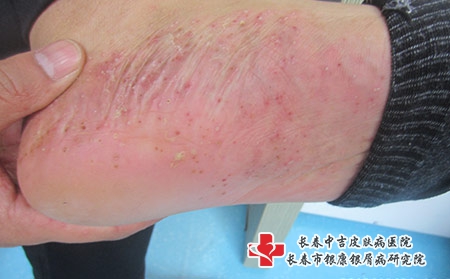银屑癣的早期症状表现有哪些