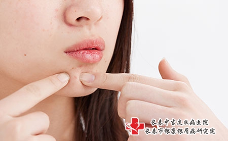 长春有名白癜风医院推举中吉!如何避免白癜风危害