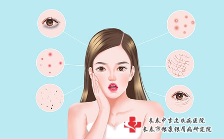 长春专科皮肤病医院品质中吉!长春中吉皮肤病医院讲解湿疹的护理?