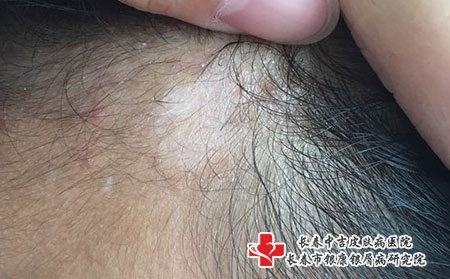 [长春白癜风医院来定长春中吉]为何白癜风越快治疗越好