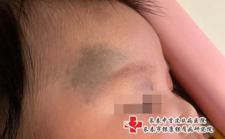 [中吉医院胎记药]长春治疗胎记贵不贵?