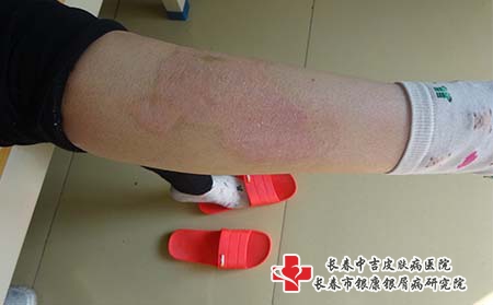 长春治疗牛皮癣的權威医院介绍几点自我管理牛皮癣的建议 长春治疗牛皮癣的權威医院介绍几点自我管理牛皮癣的建议