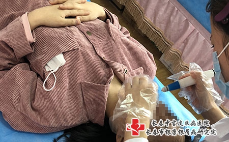 [长春医院皮肤病银屑病]牛皮癣患者在日常生活中要注意什么呢