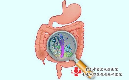 常见的诱发牛皮癣疾病发病的原因是什么?长春治疗牛皮癣去哪家好?