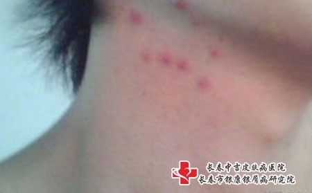 [长春中吉痤疮在哪里]痤疮的引起原因有哪些危害