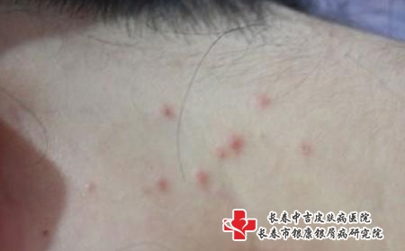 [长春治痤疮中吉尽责]在长春哪家医院治疗痤疮比较好呢?