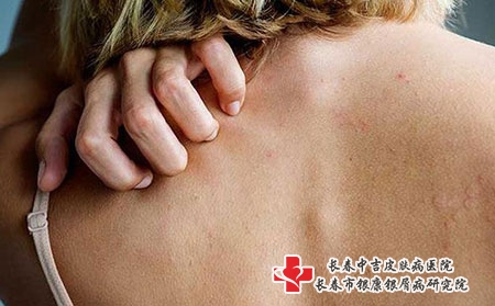 [长春专治皮肤病肯定中吉]如何才能防止湿疹反反复复的发作