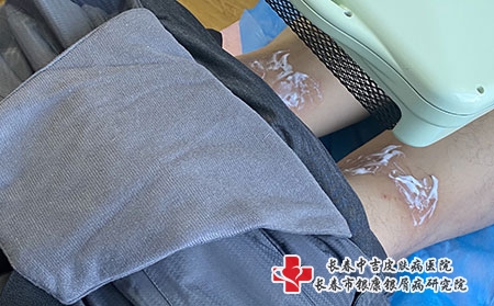 长春哪家医院治疗胎记好?治疗胎记多久能好?